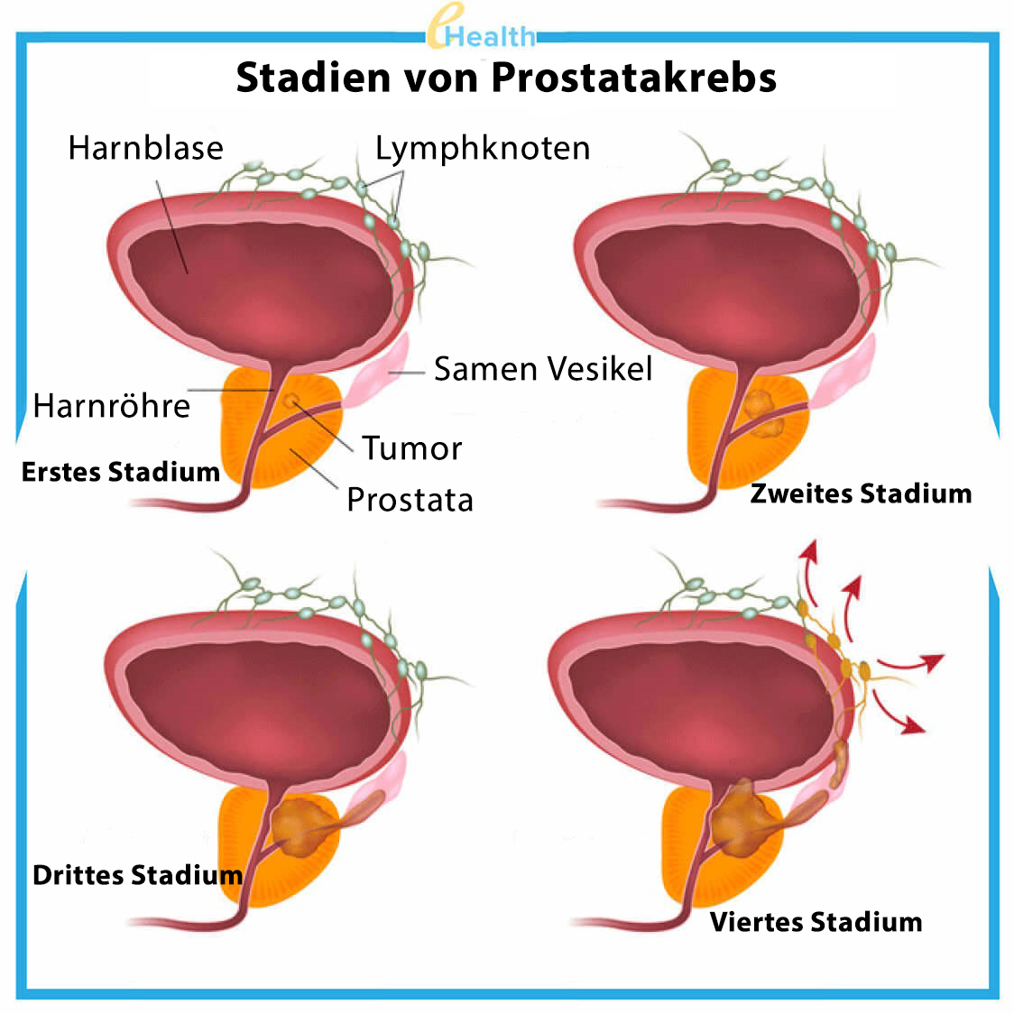 Uro UP Forte Prostatitis Produktbild 3