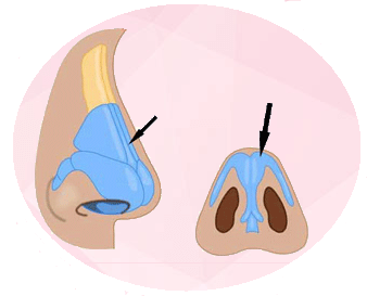 Rhinofix Produktbild 6